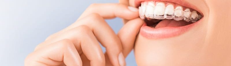 invisalign in ne calgary