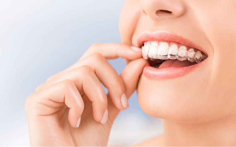 invisalign in ne calgary