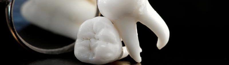 tooth extractions in ne calgary