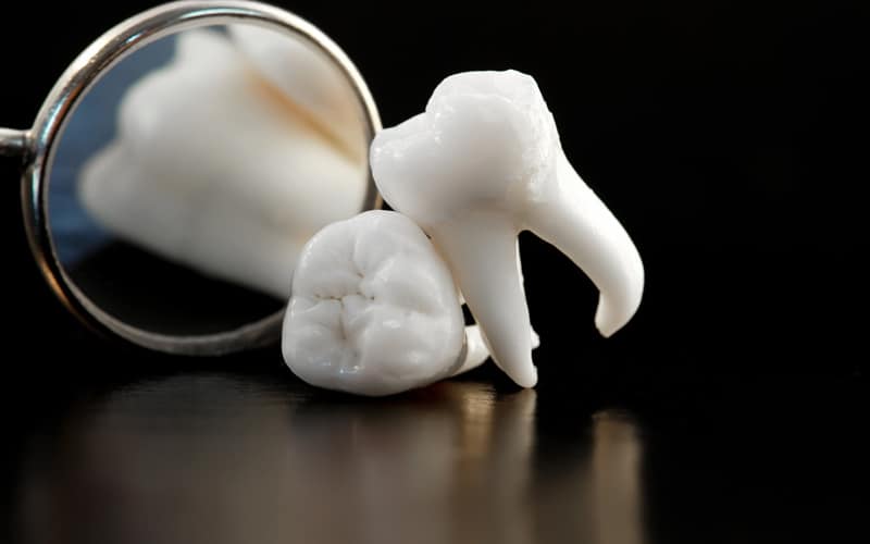 tooth extractions in ne calgary