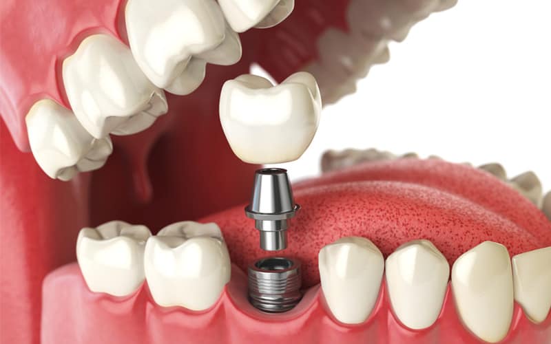 dental implants in ne calgary