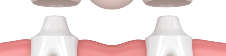 dental bridges can help you achieve a beautiful smile