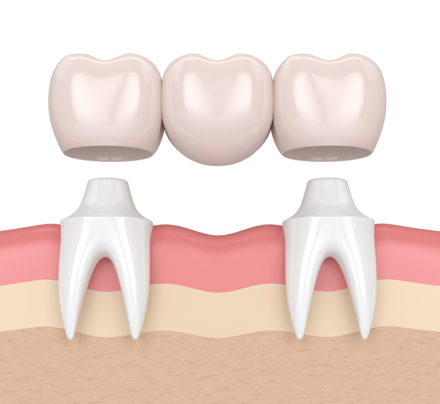 dental bridges can help you achieve a beautiful smile