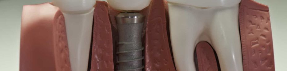 dental implants are permanent