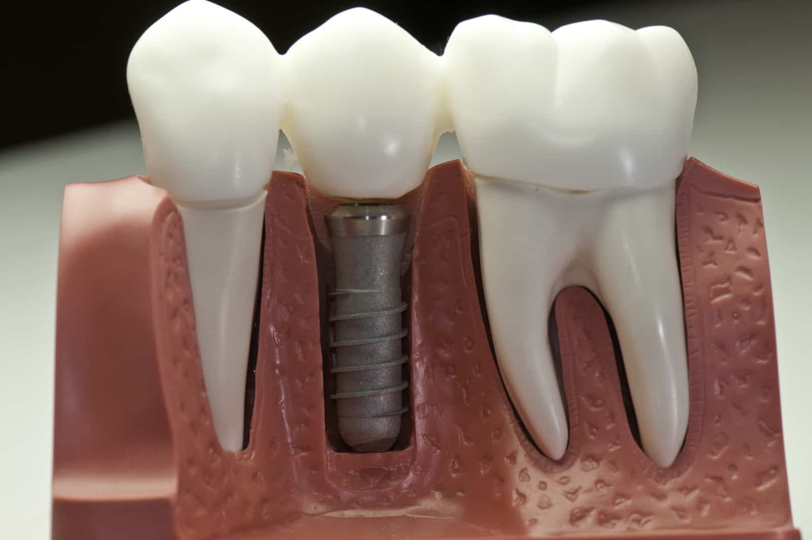 dental implants are permanent