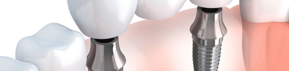 implant-supported dental bridges offer the best of both worlds