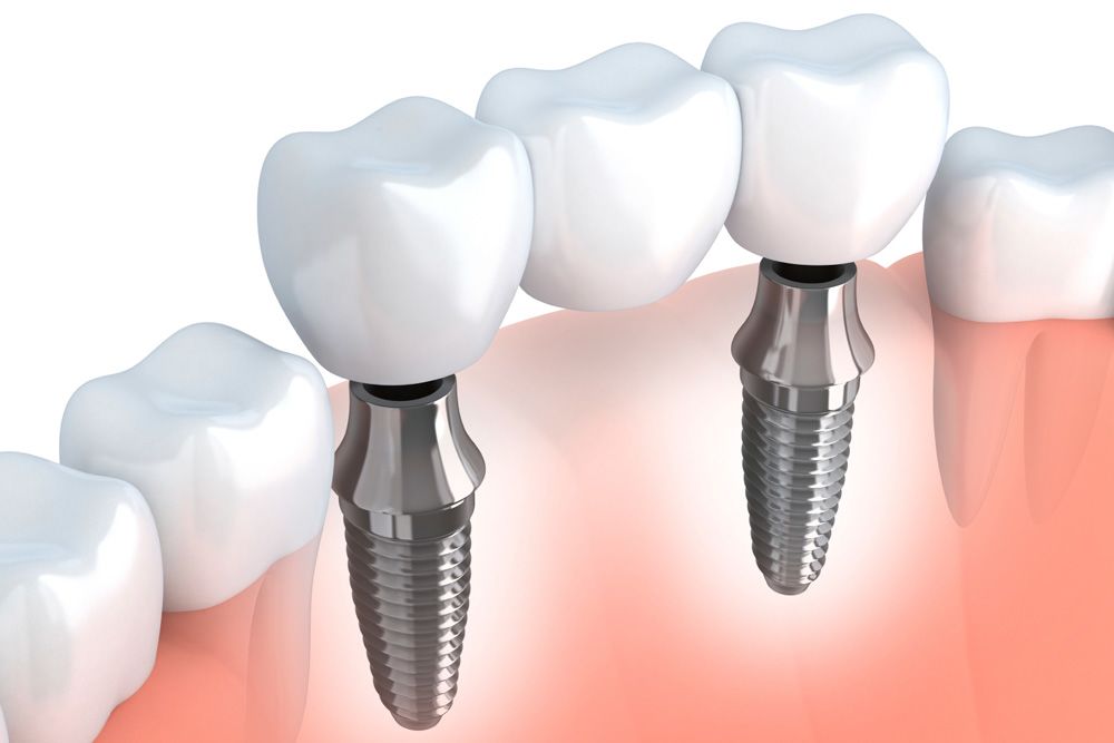 implant-supported dental bridges offer the best of both worlds