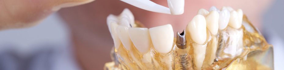 makes dental implants such a good option