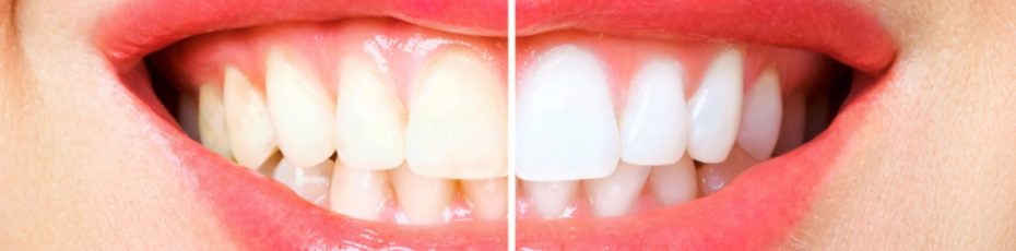 teeth whitening is addictive