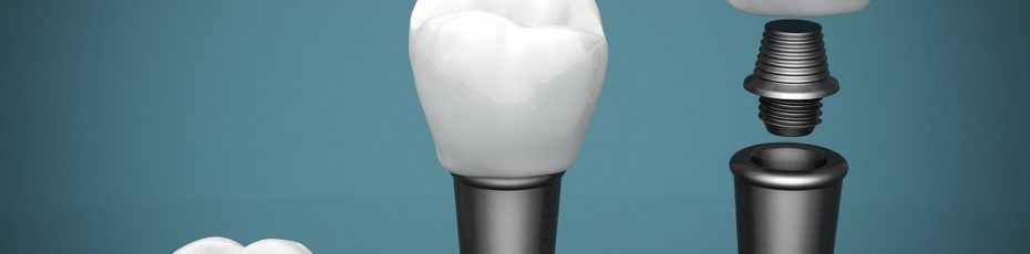 the fascinating history of dental implants