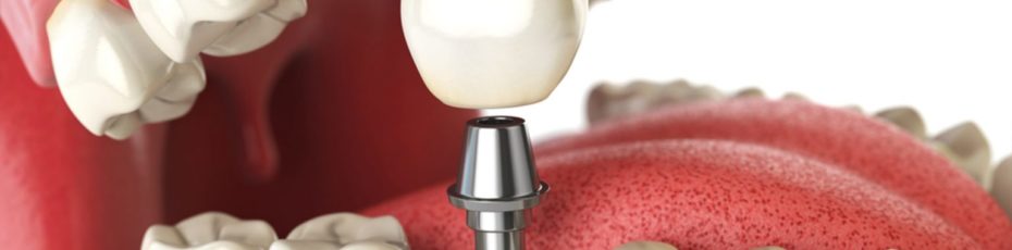 types of dental implants which one is best for you