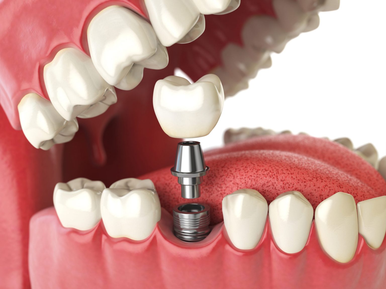 4 Types of Dental Implants (Which One Is Best for You?) - Sunridge