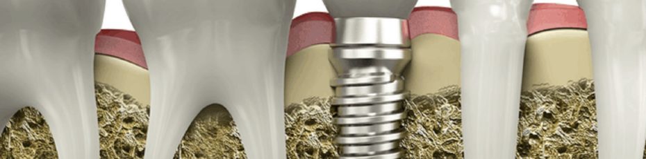 ways to take proper care of your dental implants