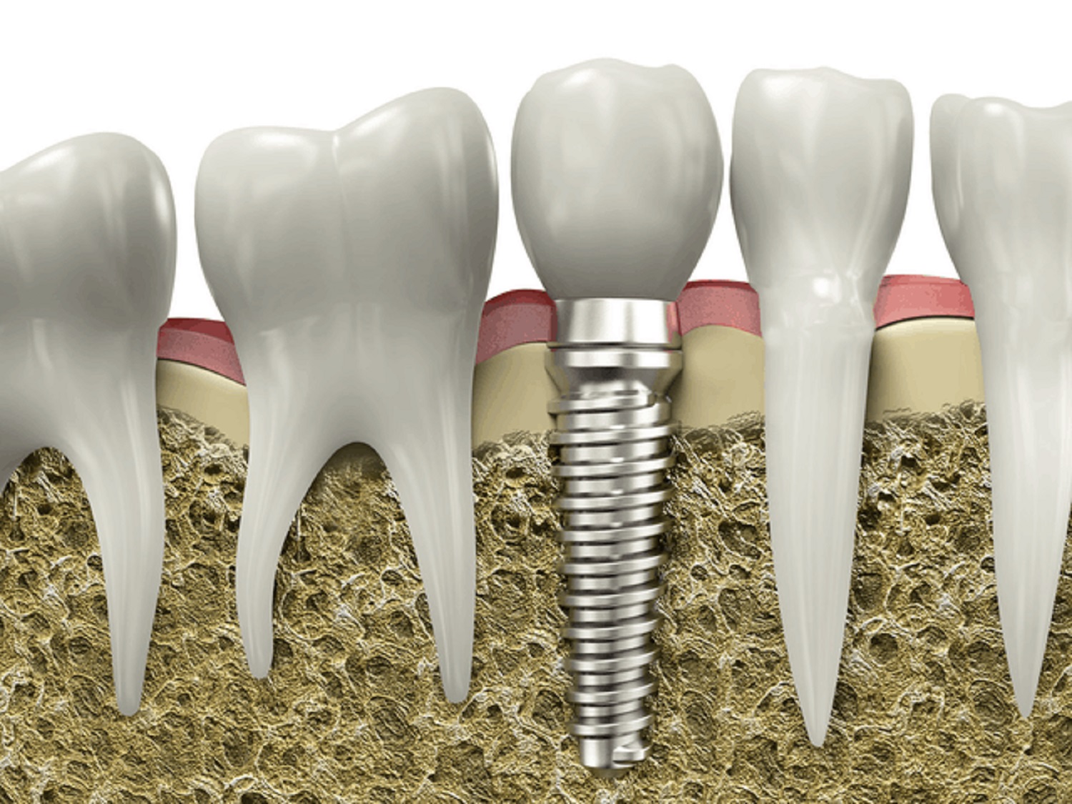 ways to take proper care of your dental implants
