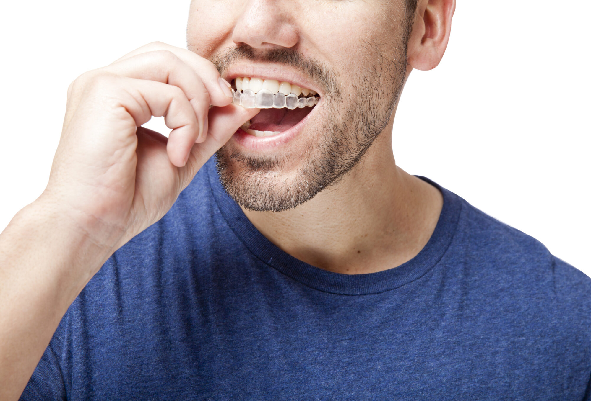 How Does the Invisalign Process Actually Work?
