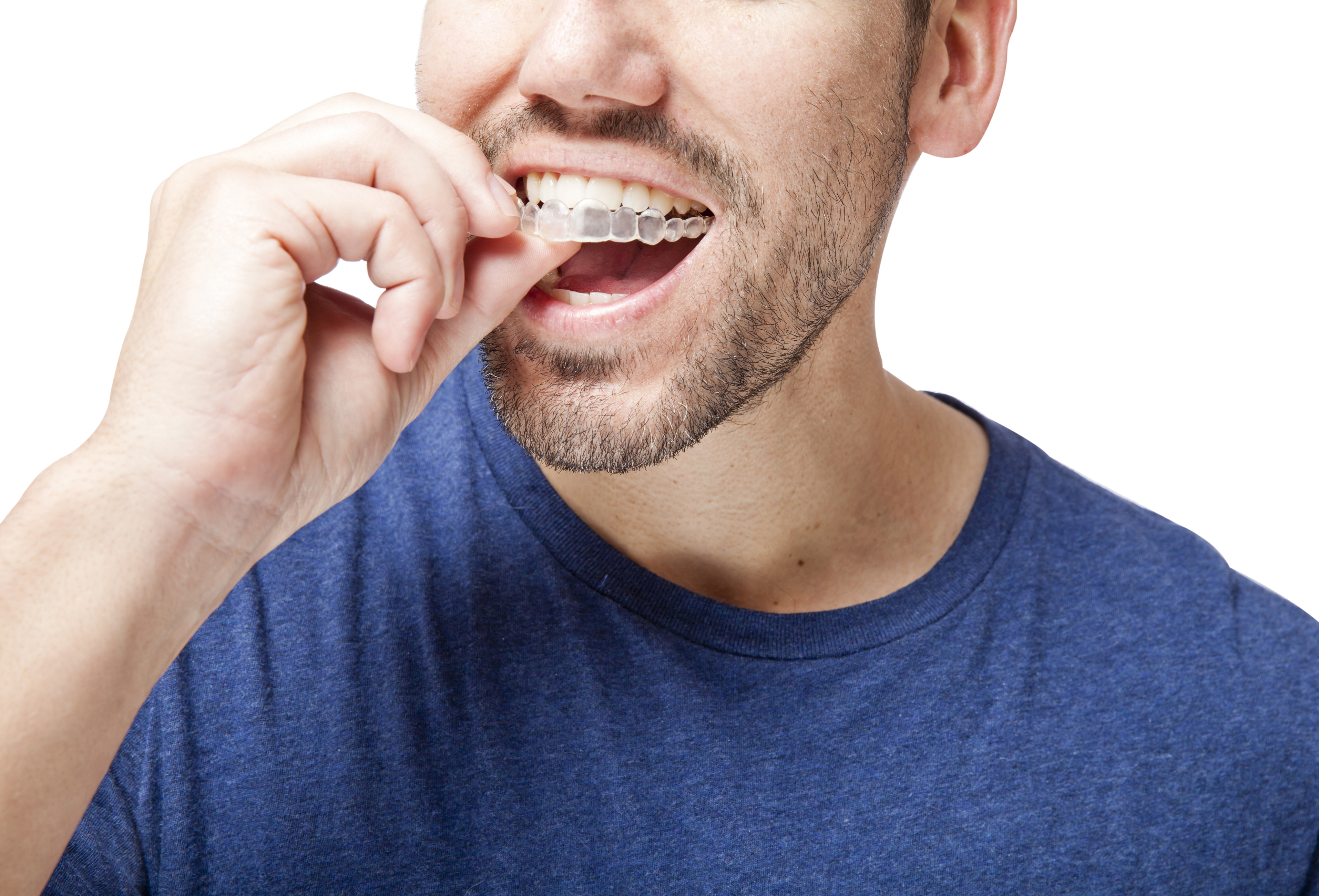 how does the invisalign process actually work