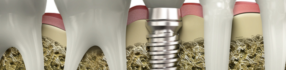 dental implant treatment