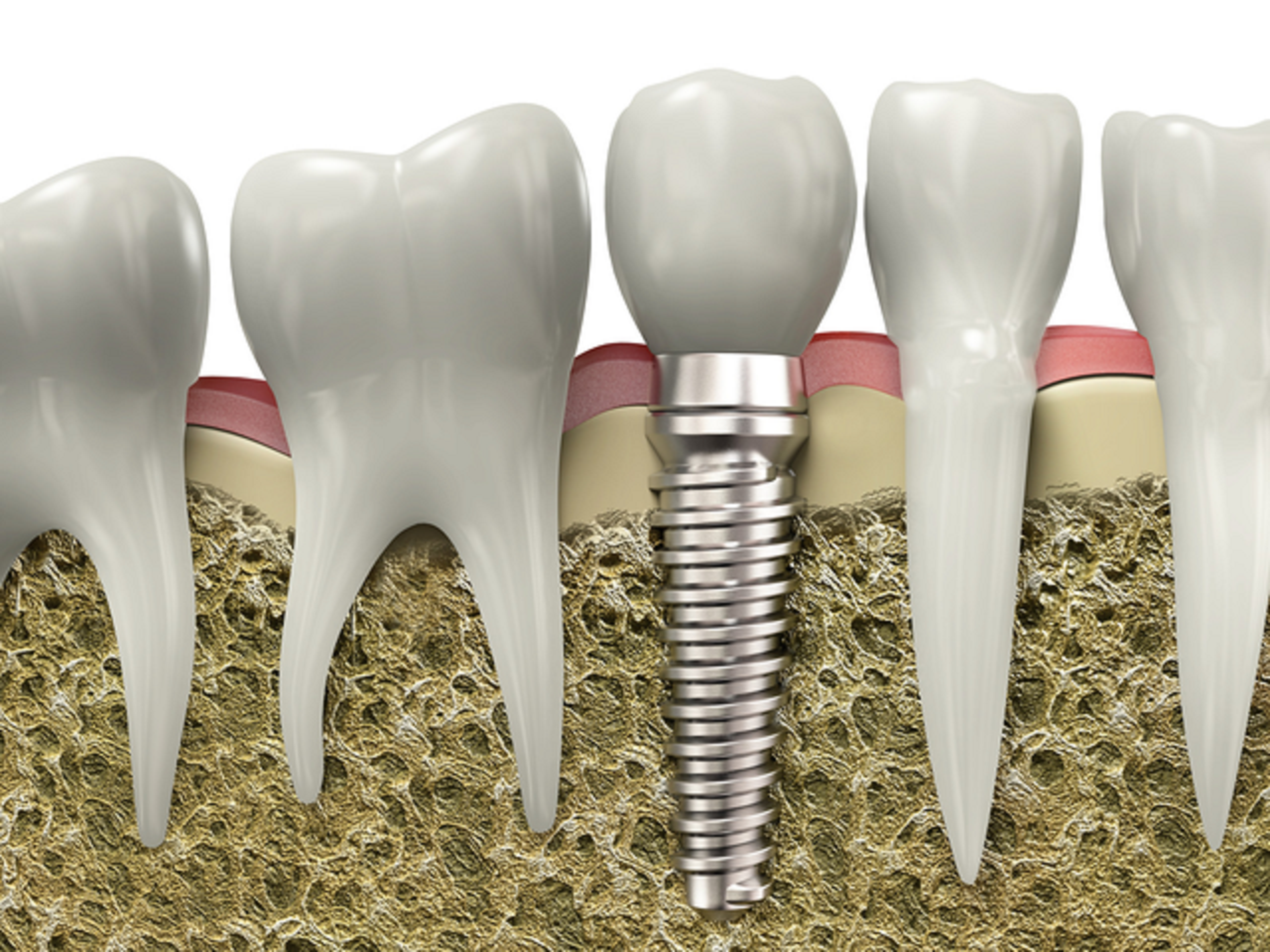 dental implant treatment