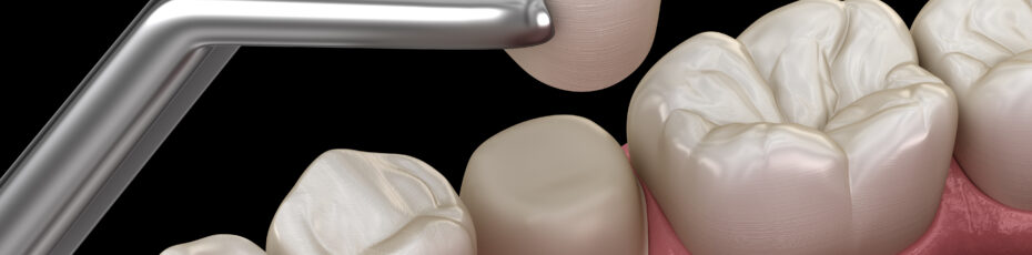 what to do if your dental crown falls off emergency care