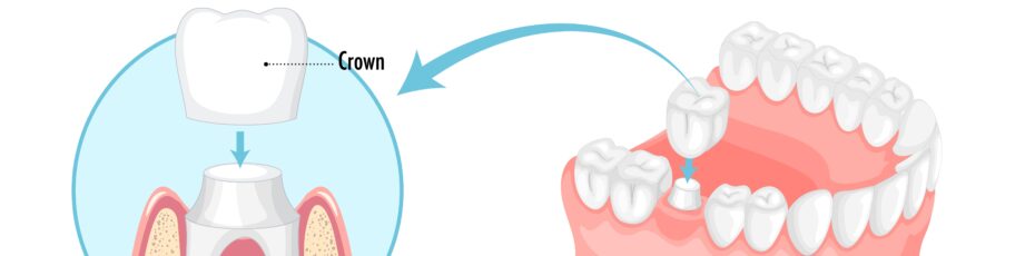 Dental Crowns in NE Calgary